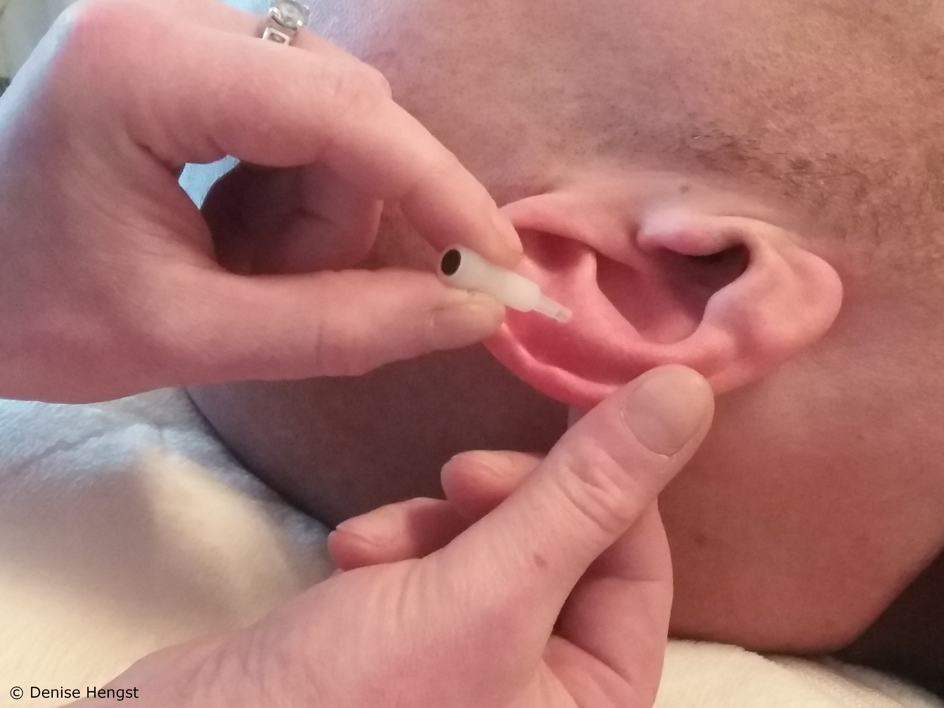 Implantat Akupunktur 1