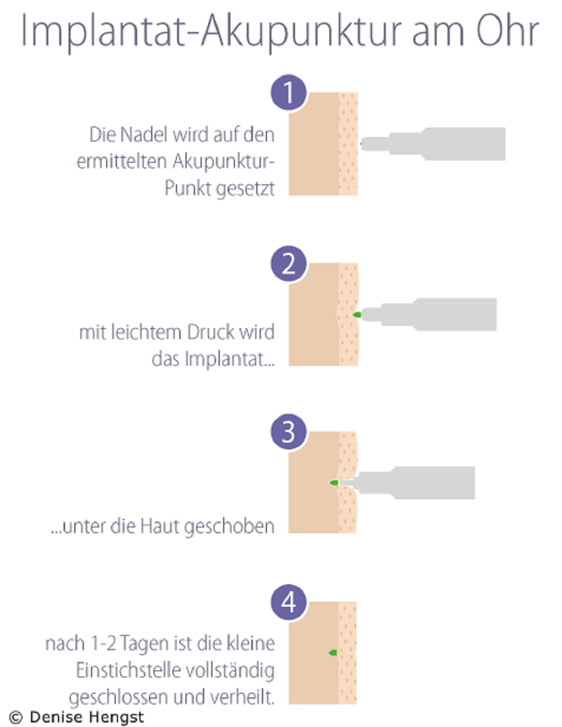 Implantat Akupunktur